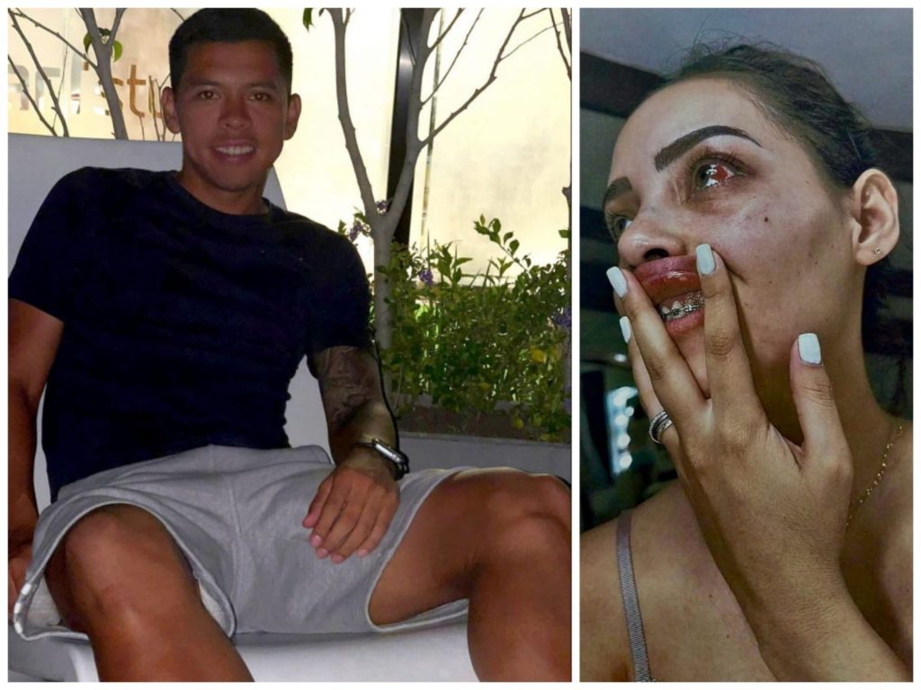 El futbolista de Real Santa Cruz, Alan Mercado, le propinó una brutal golpiza a su pareja y le desfiguró el rostro.